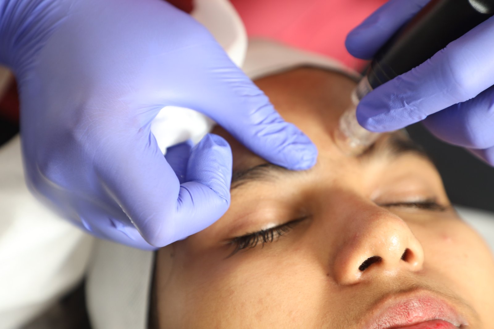 Facial mesotherapy treatment performed by a clinician