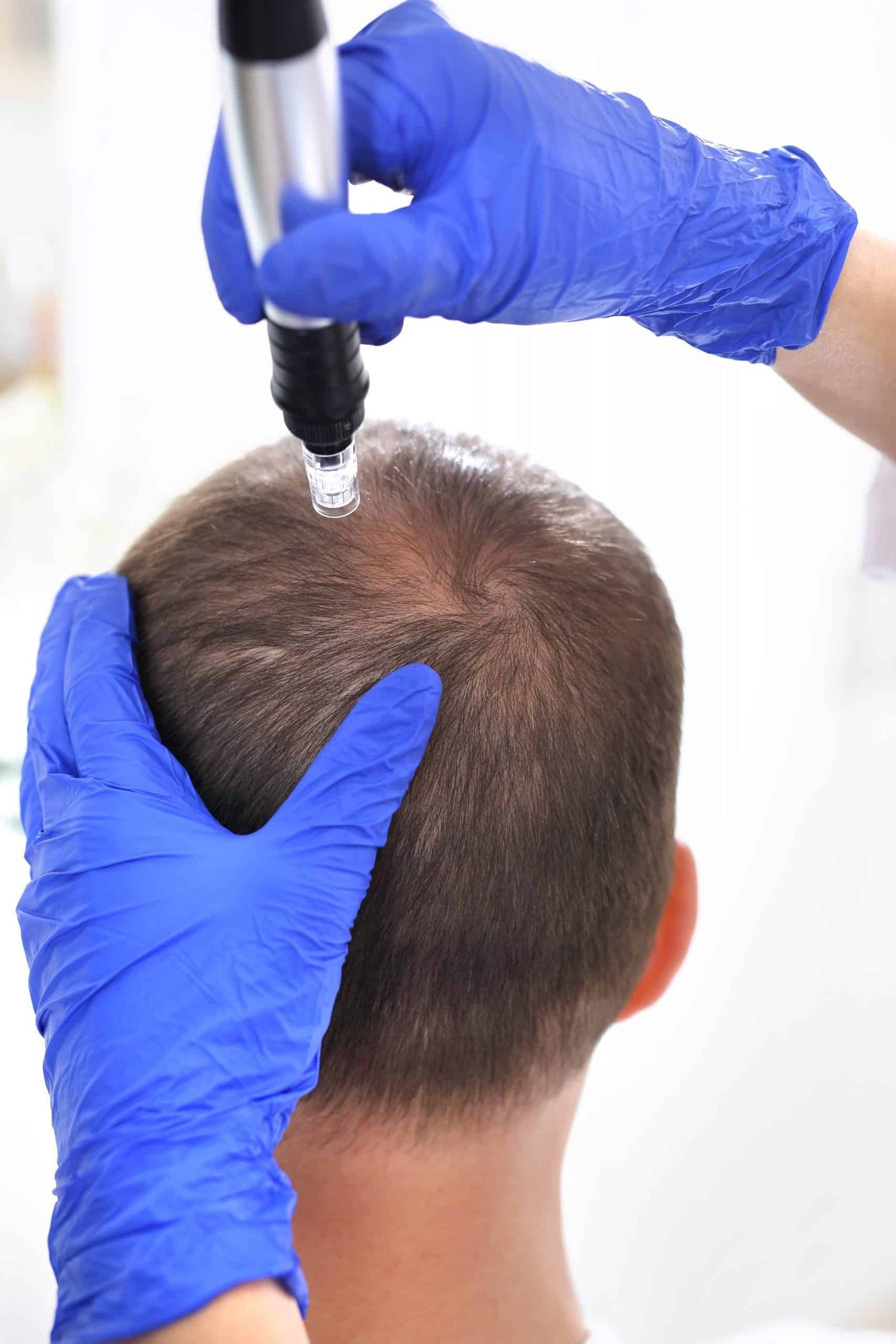 Microneedling treatment performed on the scalp