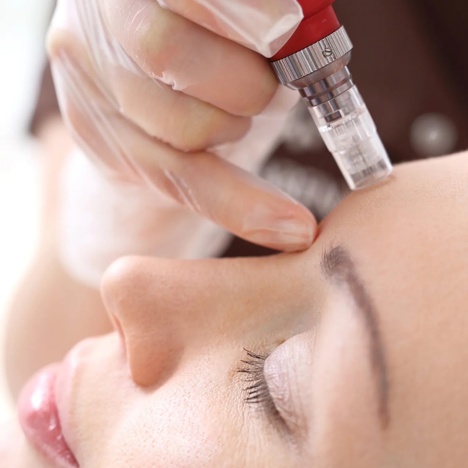 Facial microneedling treatment performed by a clinician